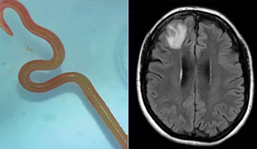 In a first, live worm found inside woman’s brain in Australia